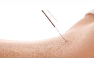 Acupuncture